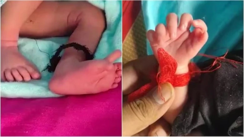 مورد عجیب نوزادی با ۲۶ انگشت که خانواده اش او را تناسخ الهه هندو می‌دانند