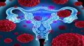 فیبروم و آندومتریوز احتمال سرطان تخمدان را افزایش می‌دهد