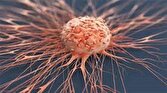 علائم زودهنگام دومین سرطان مرگبار جهان